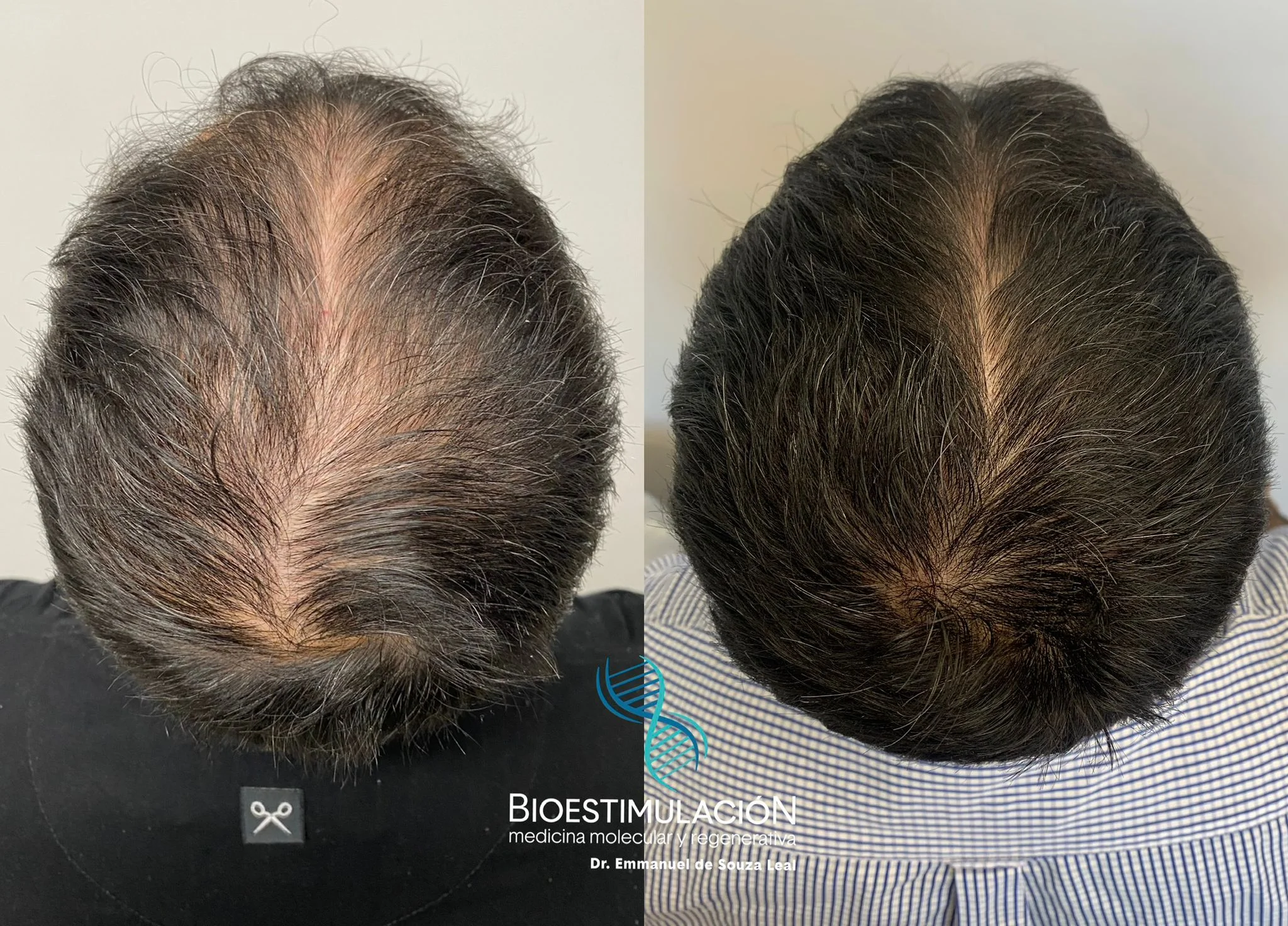 Resultado de tratamiento estético en Montevideo – Bioestimulación